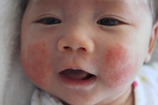 درمان اگزمای پوستی صورت و بدن نوزادان (قرمزی و خارش پوست بچه) - متخصصکودکان و نوزادان: دکتر شیخ الاسلامی